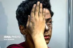 تصاویری دردناک از مصدومان چهارشنبه سوری !