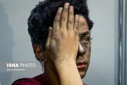 تصاویری دردناک از مصدومان چهارشنبه سوری !