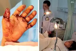 عکس/ قطع شدن 10انگشت یک کارگر