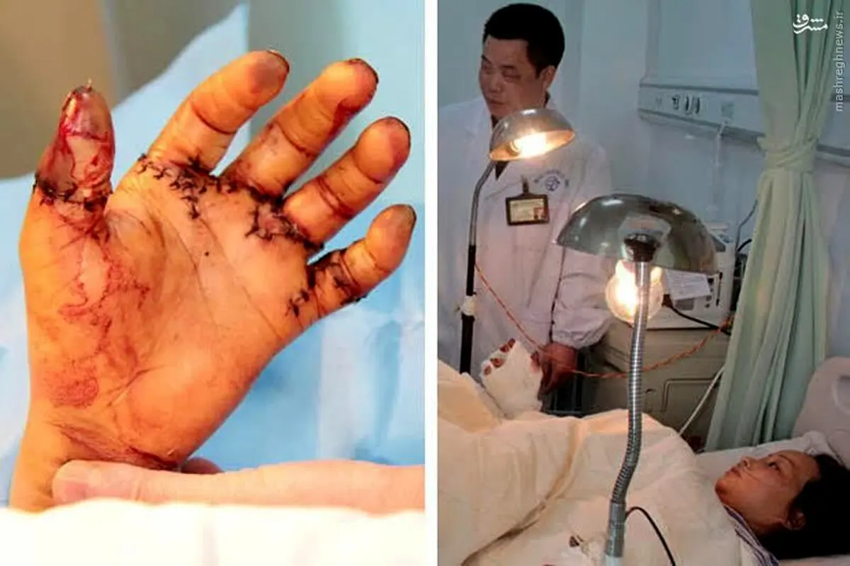 عکس/ قطع شدن 10انگشت یک کارگر