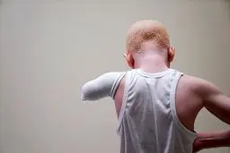 کودکان زال تانزانیایی‎ که دست‌هایشان به اتهام جادوگری قطع شد/ تصاویر