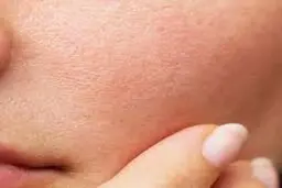 اگر پوست چرب دارید حتما این موارد را بخوانید