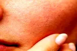 اگر پوست چرب دارید حتما این موارد را بخوانید