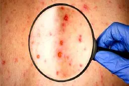 عوارض ابتلا به سرخک؛ از عفونت مغزی تا کوری/ بزرگسالان هم در معرض خطر ابتلا