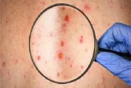 عوارض ابتلا به سرخک؛ از عفونت مغزی تا کوری/ بزرگسالان هم در معرض خطر ابتلا