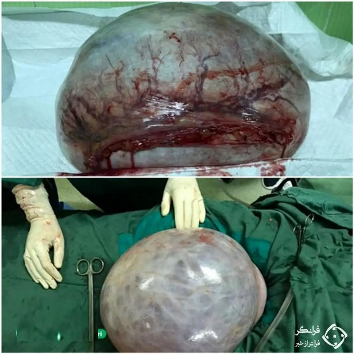 غده عجیب 11 کیلویی که امروز از شکم زن اردبیلی خارج شد + عکس