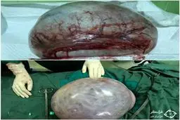 غده عجیب 11 کیلویی که امروز از شکم زن اردبیلی خارج شد + عکس