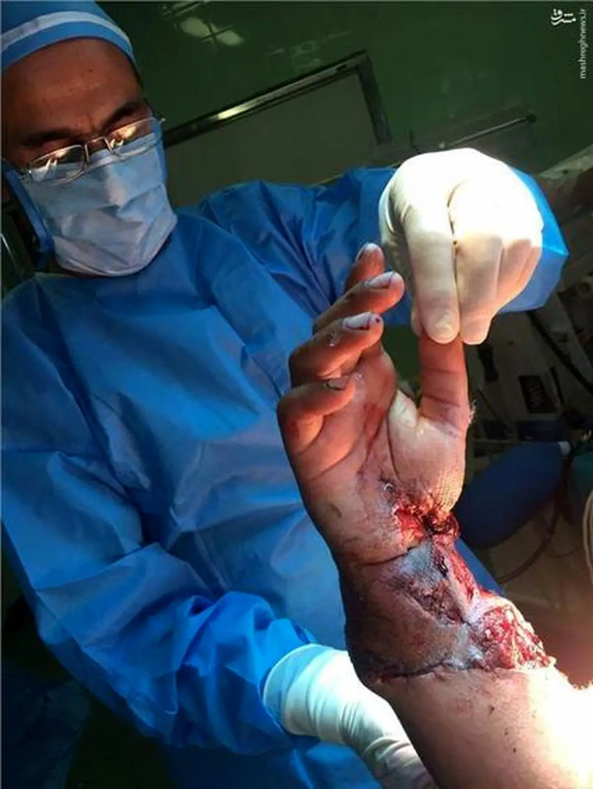 پیوند دست قطع شده در رشت +16/عکس