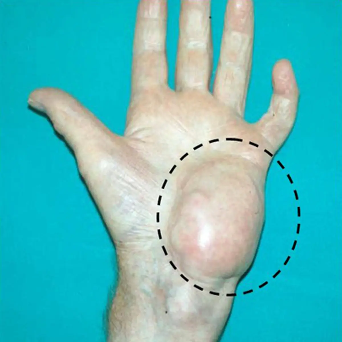 سرطان سارکوم را بشناسید! علائم،علل و درمان سارکوم