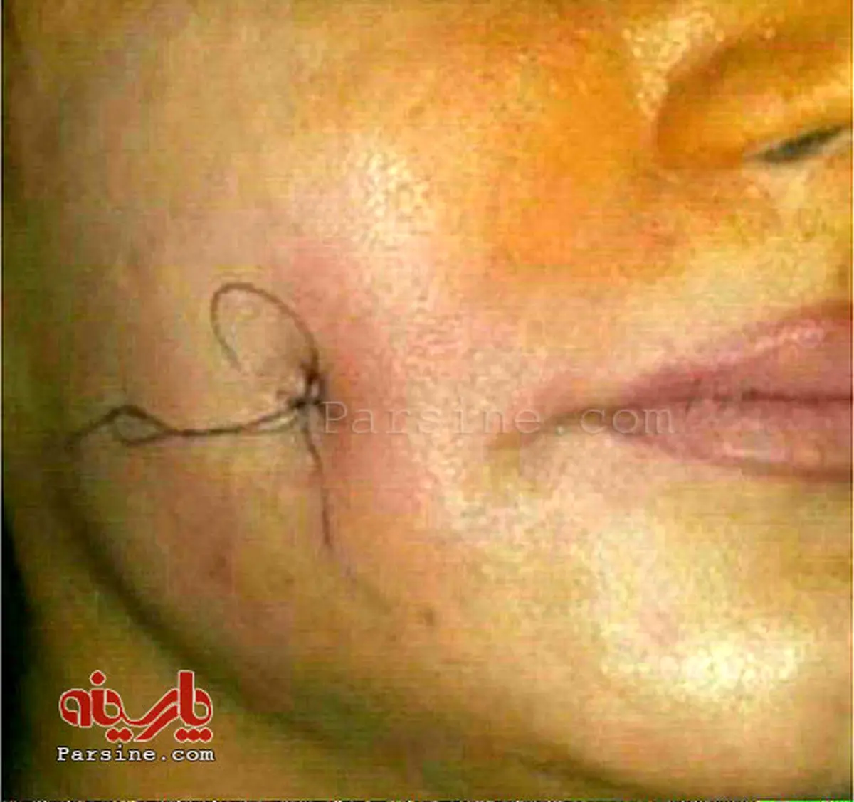 عکس/ عمل جراحی برای ایجاد چال گونه