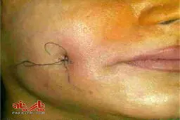 عکس/ عمل جراحی برای ایجاد چال گونه
