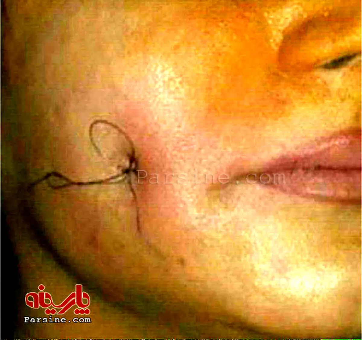 عکس/ عمل جراحی برای ایجاد چال گونه