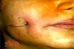 عکس/ عمل جراحی برای ایجاد چال گونه