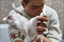 بیماران دچار سوختگی چه مواد غذایی مصرف کنند؟