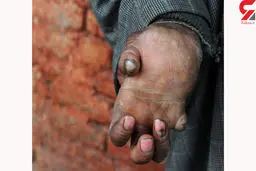 طاعون خیارکی چیست و آیا در ایران شیوع پیدا کرده است؟! + عکس