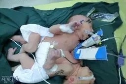 دوقلوهای به هم چسبیده در مشهد از هم جدا شدند/عکس