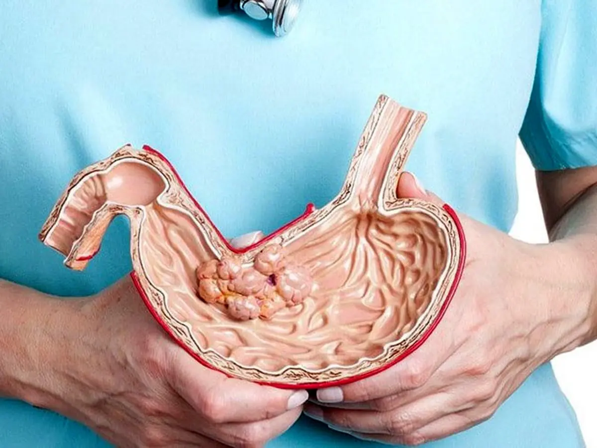 این نکات را قبل از عمل اسلیو باید بدانید
