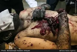 عکس/ وحشتناک ترین مصدوم چهارشنبه سوری