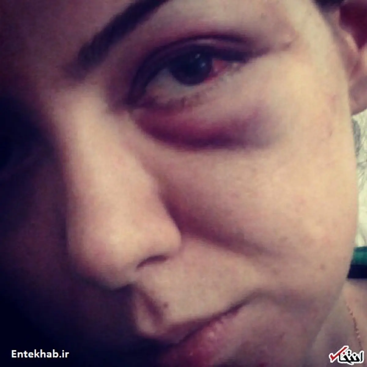 ادعای «آزاده نامداری» از ضرب‌وشتم خود توسط فرزاد حسنی + عکس