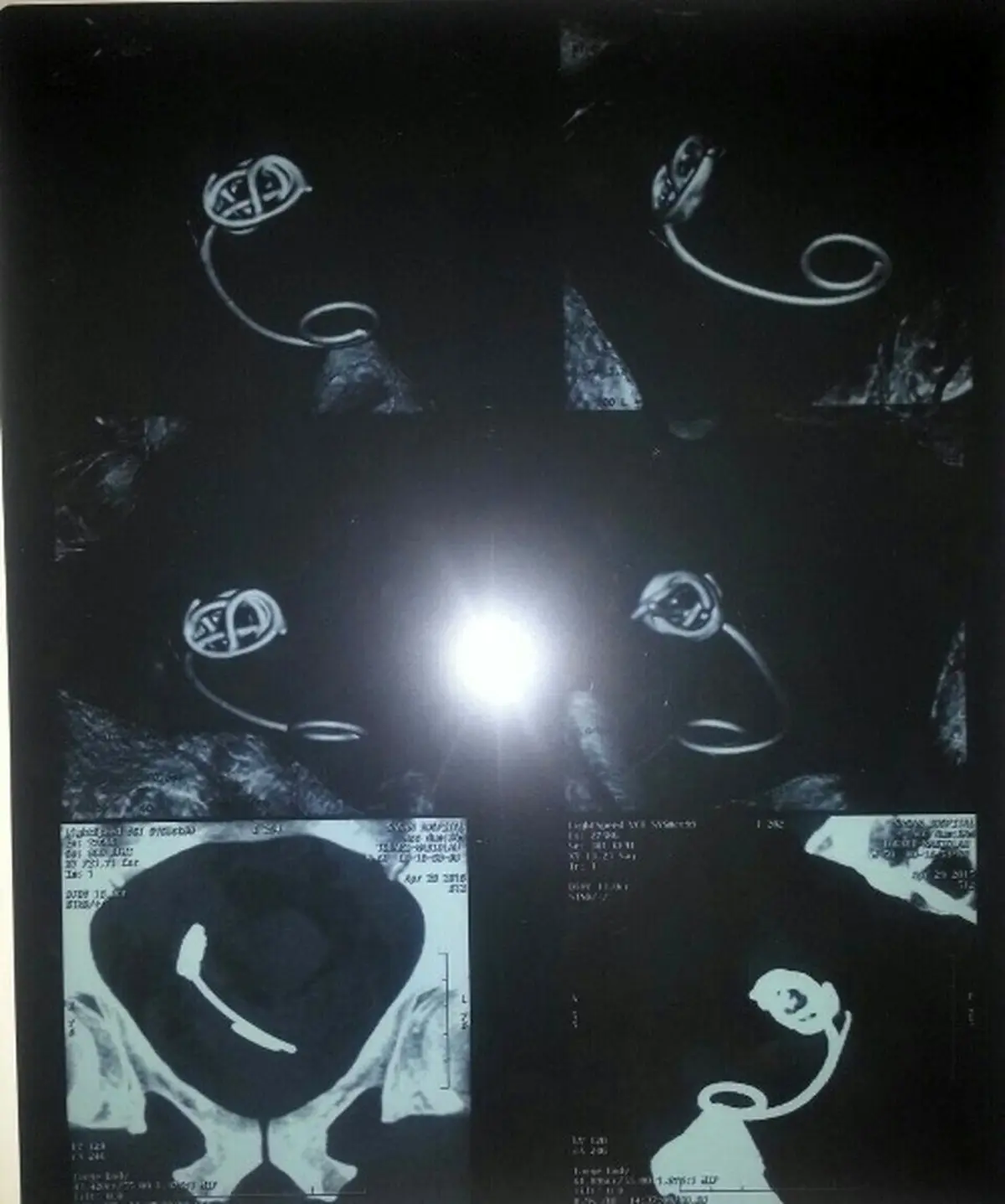 جاگذاشتن شلنگ 20 سانتی در شکم بیمار+عکس