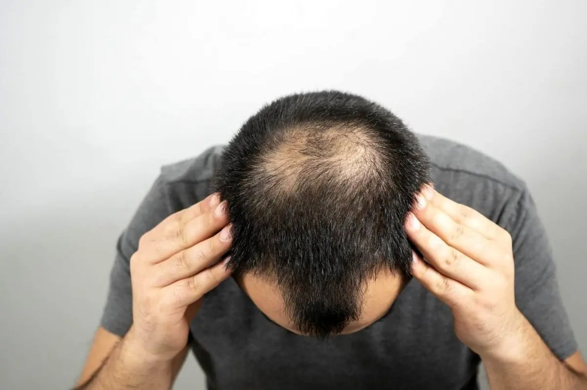 آیا ریزش مو از عوارض طبیعی کروناست؟