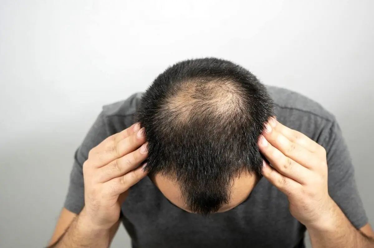 آیا ریزش مو از عوارض طبیعی کروناست؟