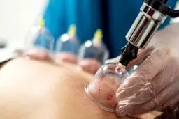 نقش حجامت در تضمین سلامتی