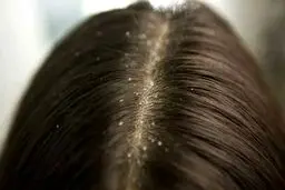 شوره سر و راه های کاهش آن