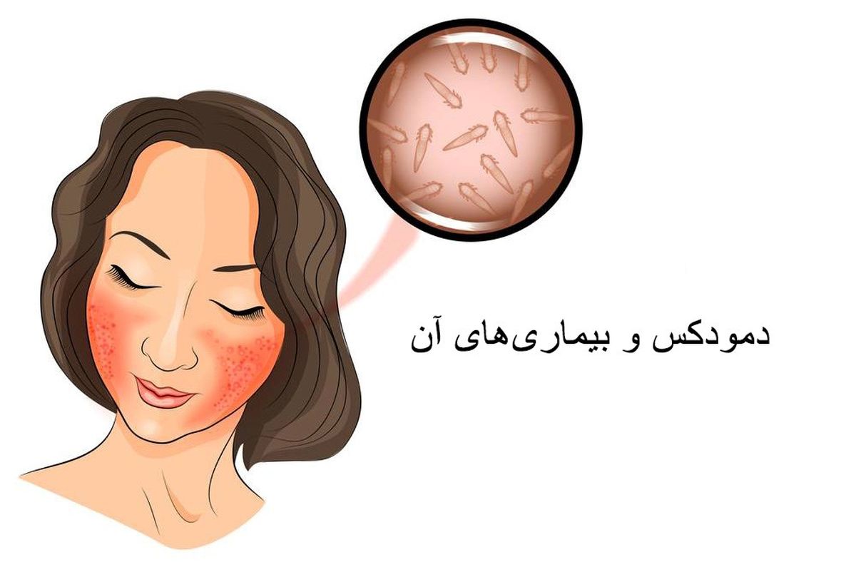 همه چیز در مورد دمودکس و درمان تخصصی این عارضه پوستی