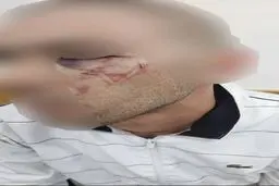 عکس/ اقدام وحشیانه صهیونیست‌ها در آسیب به صورت یک فلسطینی