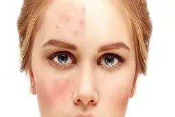 درمان سه سوته جوش صورت با این روش