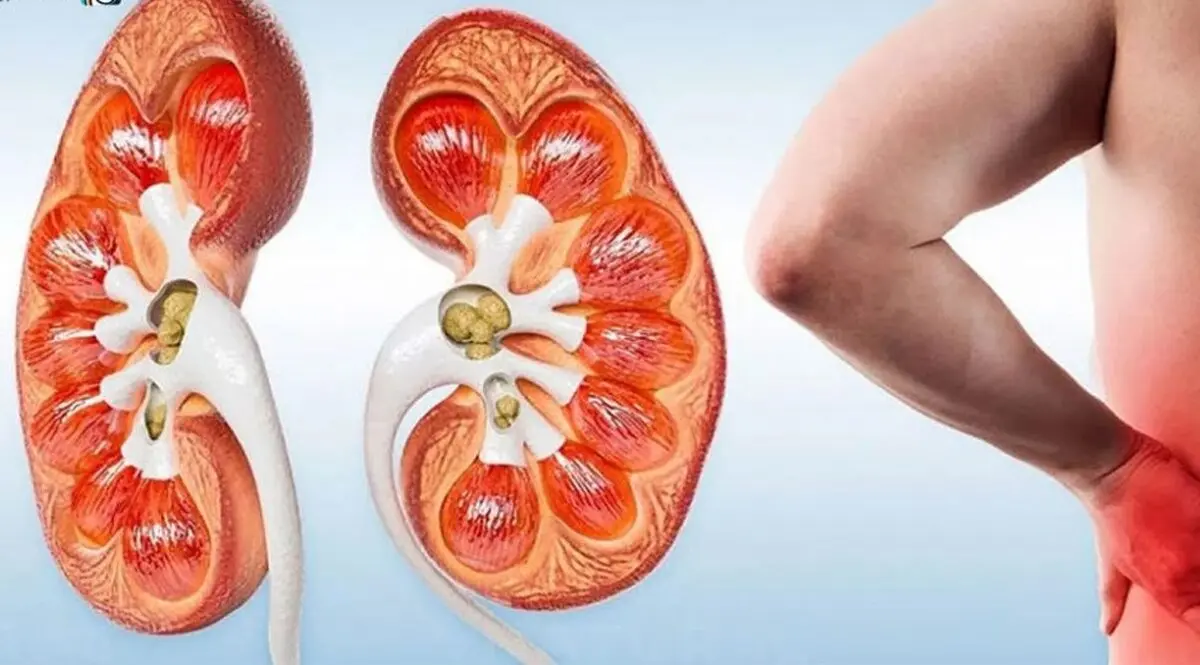 با این میوه تابستانی به جنگ سنگ کلیه بروید