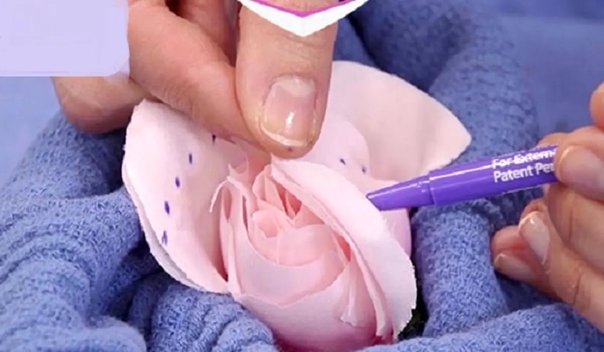 چقدر با جراحی لابیاپلاستی آشنایی دارید؟