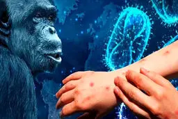 خبر ترسناک وزارت بهداشت درخصوص «آبله میمونی 1b» 