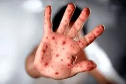خبر هولناک درباره آبله میمونی + جزئیات