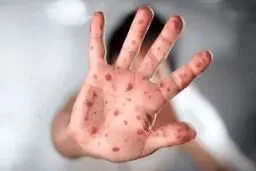 هشدار؛ انتقال آبله میمونی از طریق هوا ! + جزئیات