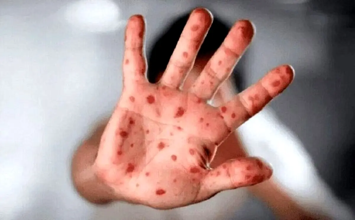 خبر هولناک درباره آبله میمونی + جزئیات