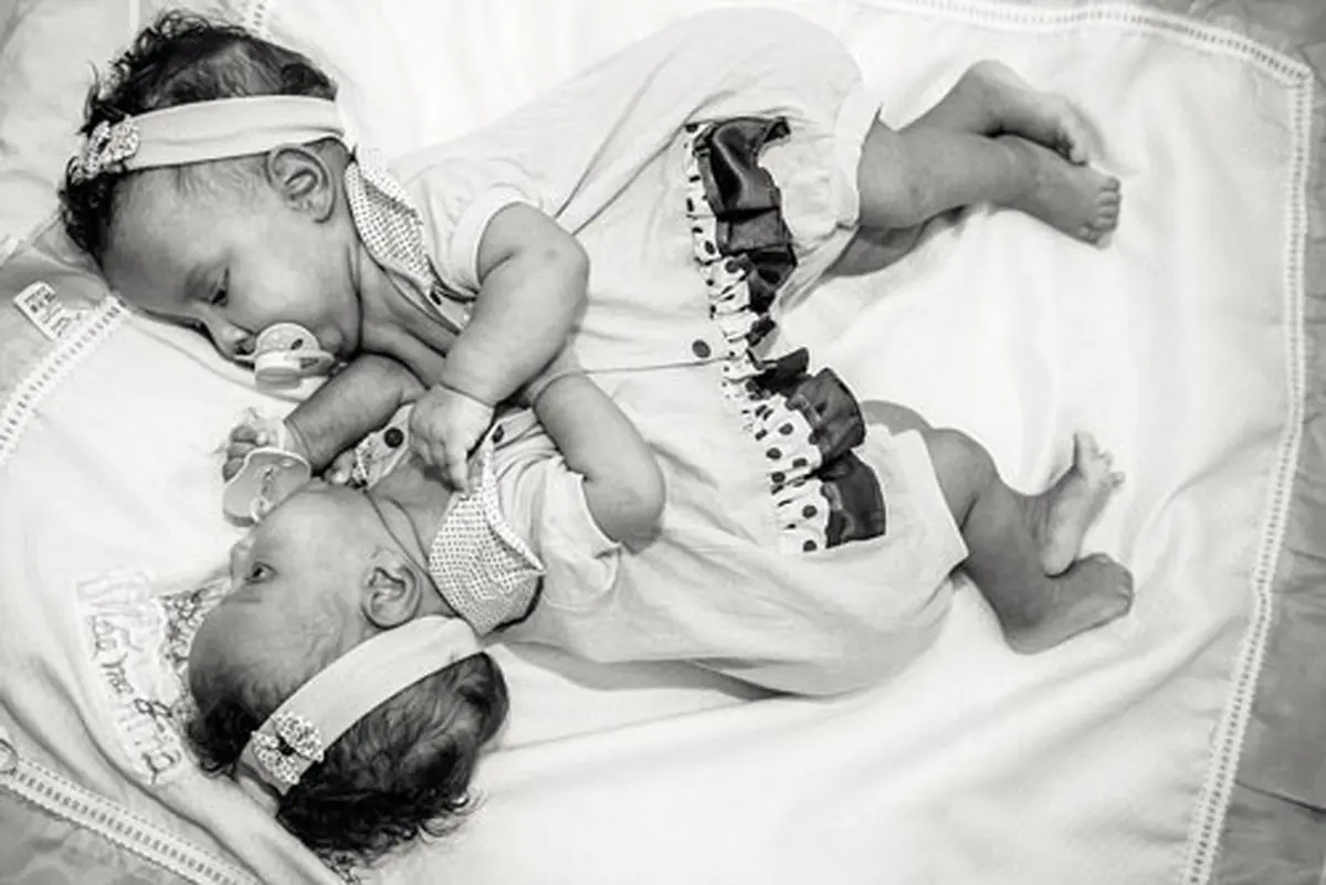 دوقلوهای به هم چسبیده برزیلی پس از جدایی/عکس