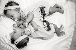 دوقلوهای به هم چسبیده برزیلی پس از جدایی/عکس