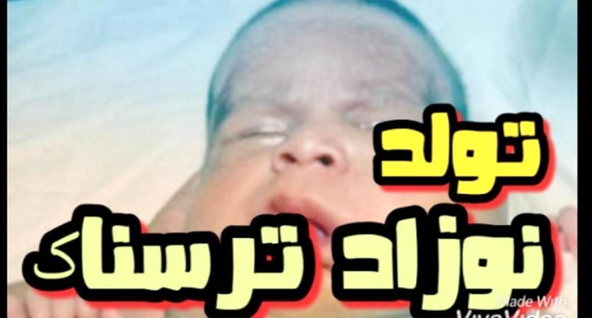 عکس ترسناک از تولد نوزادی با 2 سر و 3 دست! + جزئیات عجیب