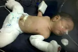 تصاویر/ نوزادی که باردار به دنیا آمد!