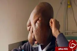 تومور عجیب در صورت پسر 11 ساله