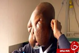 تومور عجیب در صورت پسر 11 ساله