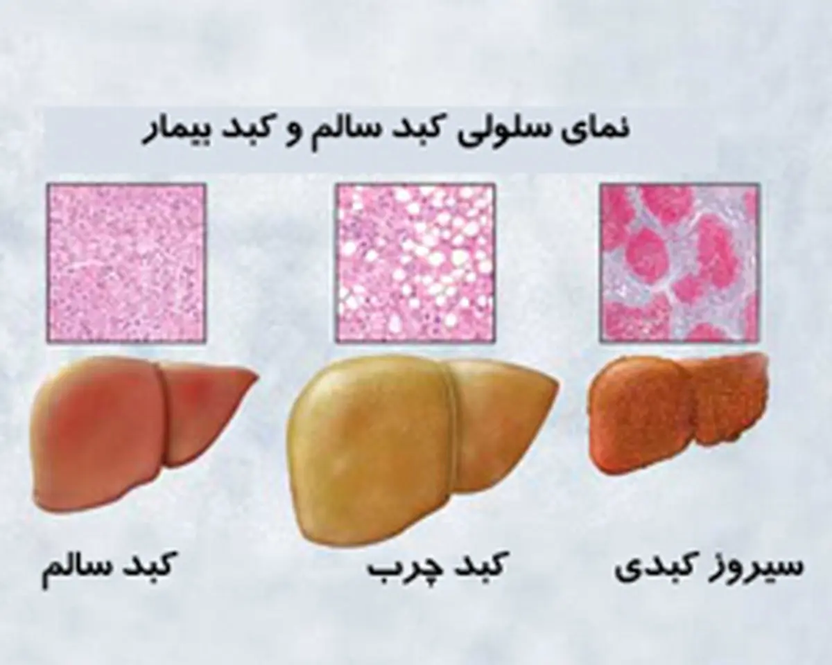 چرا کبد چرب می‌شود؟