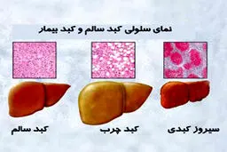 چرا کبد چرب می‌شود؟