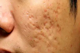 تاثیر مکمل های ورزشی بر پوست صورت چیست؟