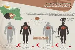 پلاسما درمانی چیست و چگونه انجام می‌شود؟ + اینفوگرافی