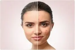 با این آنتی بیوتیک با آکنه و سکته خداحافظی کنید