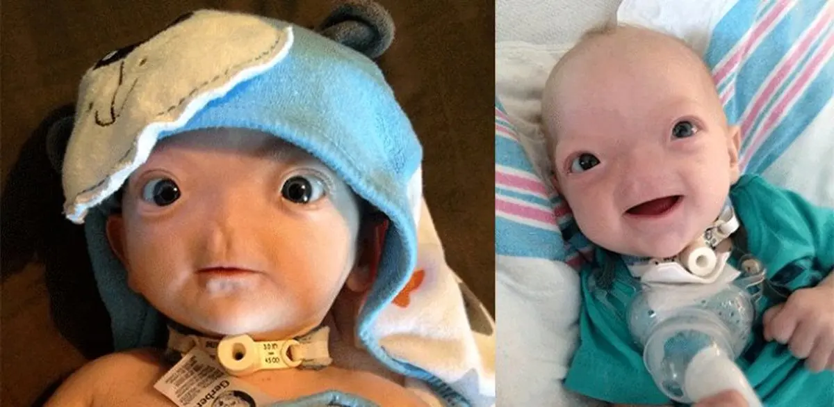 پسری که بدون بینی متولد شد (+عکس)