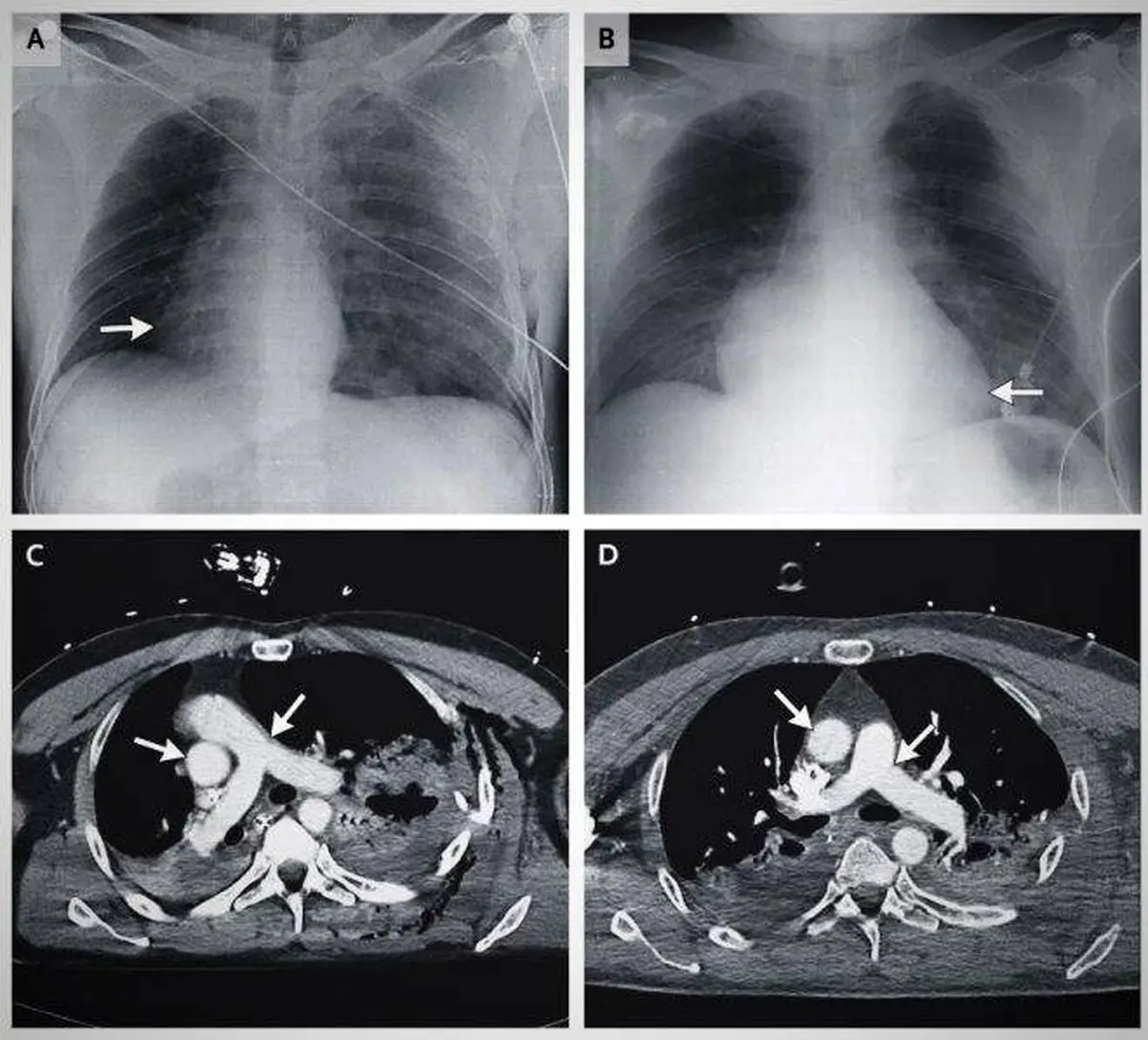 جا به جا شدن قلب یک مرد بر اثر تصادف! + عکس